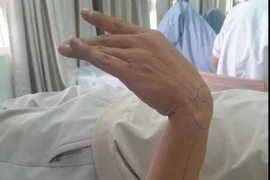 Liệt thần kinh quay do tư thế ngủ sai, cẩn thận mất chức năng vận động