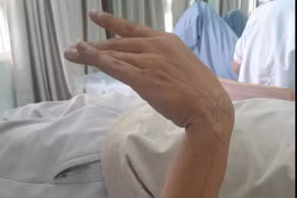 Liệt thần kinh quay do tư thế ngủ sai, cẩn thận mất chức năng vận động