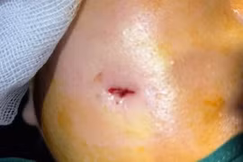 Người phụ nữ bị biến chứng sau phẫu thuật thẩm mỹ tạo má lúm