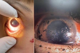 Nhiều ca chấn thương mắt nghiêm trọng do pháo nổ Tết 2026