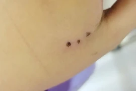 Nguy cơ mắc nhiều bệnh nguy hiểm từ vết cắn của chuột