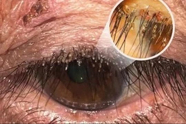 Rận mu ký sinh ở mí mắt người phụ nữ