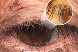 Rận mu ký sinh ở mí mắt người phụ nữ