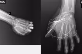 Nam thanh niên tổn thương nghiêm trọng do tai nạn pháo nổ