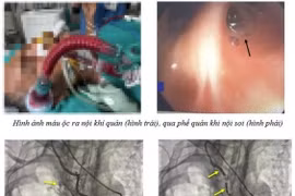 Hiếm gặp, ho ra máu ồ ạt từ nhánh lớn của động mạch vú