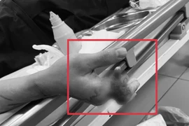 12 giờ vi phẫu nối 4 ngón tay đứt rời cho chàng trai 25 tuổi