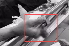 12 giờ vi phẫu nối 4 ngón tay đứt rời cho chàng trai 25 tuổi