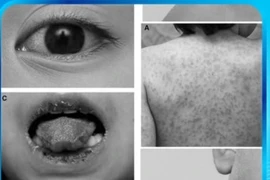 Sốt cao kéo dài, cần cảnh giác bệnh lạ đe dọa tính mạng