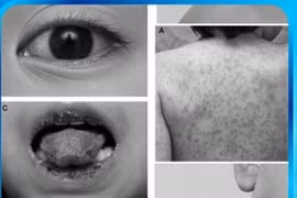 Sốt cao kéo dài, cần cảnh giác bệnh lạ đe dọa tính mạng