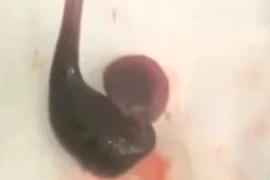 Gắp con đỉa dài 4 cm sống cả tuần trong mũi người đàn ông