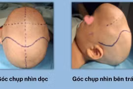 Tạo hình hộp sọ cho bé 10 tháng tuổi bị biến dạng hộp sọ