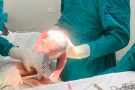 Sản phụ 20 tuổi mang thai lần 4 phải cắt tử cung vì viêm phúc mạc ruột thừa