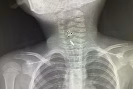 Gắp thành công kẹp tóc trong thực quản bé 5 tuổi ở Phú Thọ 