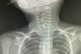 Gắp thành công kẹp tóc trong thực quản bé 5 tuổi ở Phú Thọ 