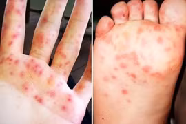 Gia tăng bệnh tay chân miệng, cần biết cách phòng ngừa