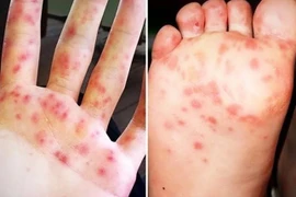 Gia tăng bệnh tay chân miệng, cần biết cách phòng ngừa