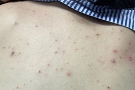 Cứu sống bệnh nhân 46 tuổi mắc thủy đậu biến chứng nặng tại Tây Ninh