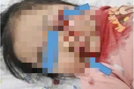 Cấp cứu bé gái hơn 2 tuổi bị chấn thương nặng do vô tình vặn tay ga xe máy