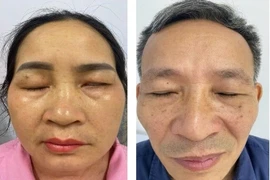 Cẩn thận virus Zona tái hoạt ở dây thần kinh mặt gây liệt