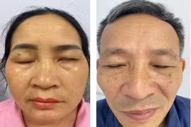 Cẩn thận virus Zona tái hoạt ở dây thần kinh mặt gây liệt