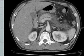 Cứu sống người đàn ông có men tụy, mỡ máu tăng cao gấp 12 lần cho phép