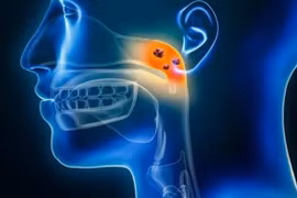 'Thủ phạm' âm thầm dẫn tới ung thư vòm họng