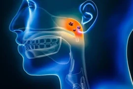 'Thủ phạm' âm thầm dẫn tới ung thư vòm họng