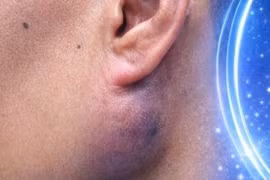 Chủ quan sưng góc hàm không đau nào ngờ u tuyến nước bọt mang tai