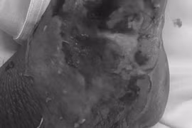 Chủ quan rắn cắn, nhập viện cấp cứu vì vết thương nhiễm trùng