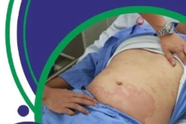 Sốc phản vệ độ 2 sau khi ăn cơm với cá thu