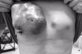 Sờ thấy khối u đi khám phát hiện u vú khổng lồ, di căn xương