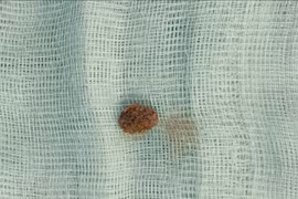 Bé 9 tuổi đau quặn thận do sỏi niệu quản