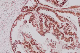 Ung thư đồng phát ở dạ dày - đại tràng, dấu hiệu ít ngờ tới