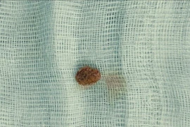 Bé 9 tuổi đau quặn thận do sỏi niệu quản