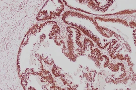 Ung thư đồng phát ở dạ dày - đại tràng, dấu hiệu ít ngờ tới