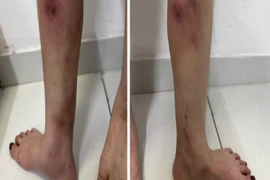 Tiêm filler làm thẳng chân tại nhà gây biến dạng, nguy cơ hoại tử