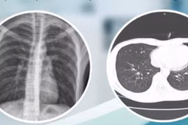 Trẻ khỏe mạnh tràn khí màng phổi mức độ nặng do vỡ kén khí