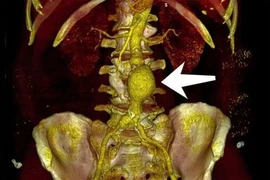 Nhiều người nhập viện vì phình động mạch chủ, căn bệnh nguy hiểm dễ tử vong
