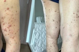 Cảnh giác với tổn thương da dai dẳng, nguy cơ bệnh hiếm