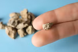 'Thủ phạm' âm thầm nuôi dưỡng sỏi thận