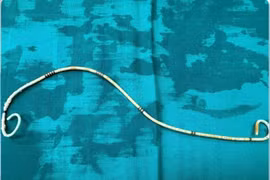 Sỏi bám dày đặc quanh ống sonde JJ bị bỏ quên 3 năm