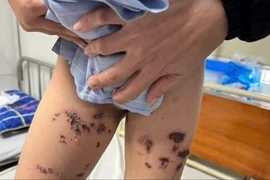 Nước tẩy bồn cầu bắn vào người, bé trai ở Nghệ An bị bỏng nặng