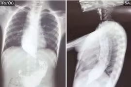 Nuốt nghẹn suốt 3 năm, bé trai 10 tuổi mắc co thắt tâm vị hiếm gặp