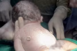 Can thiệp bào thai, em bé ra đời khỏe mạnh với 'đôi cánh nhỏ' trên lưng