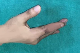 Lần đầu tiên tại Việt Nam, vi phẫu cứu sống ngón tay đứt rời sau 25 giờ