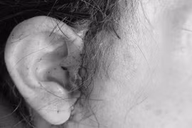 Người phụ nữ 64 tuổi biến chứng nặng sau khi căng da mặt