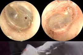 Phát hiện bọ chó sống trong tai người phụ nữ 60 tuổi