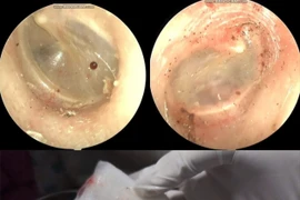 Phát hiện bọ chó sống trong tai người phụ nữ 60 tuổi