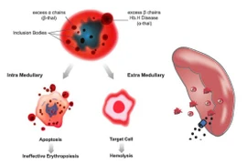 Phát hiện trẻ 19 tháng mắc đột biến gen Thalassemia từ dấu hiệu da nhợt, còi