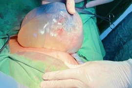 Hiếm gặp song sinh chung buồng ối, một bé “đẻ bọc điều” 